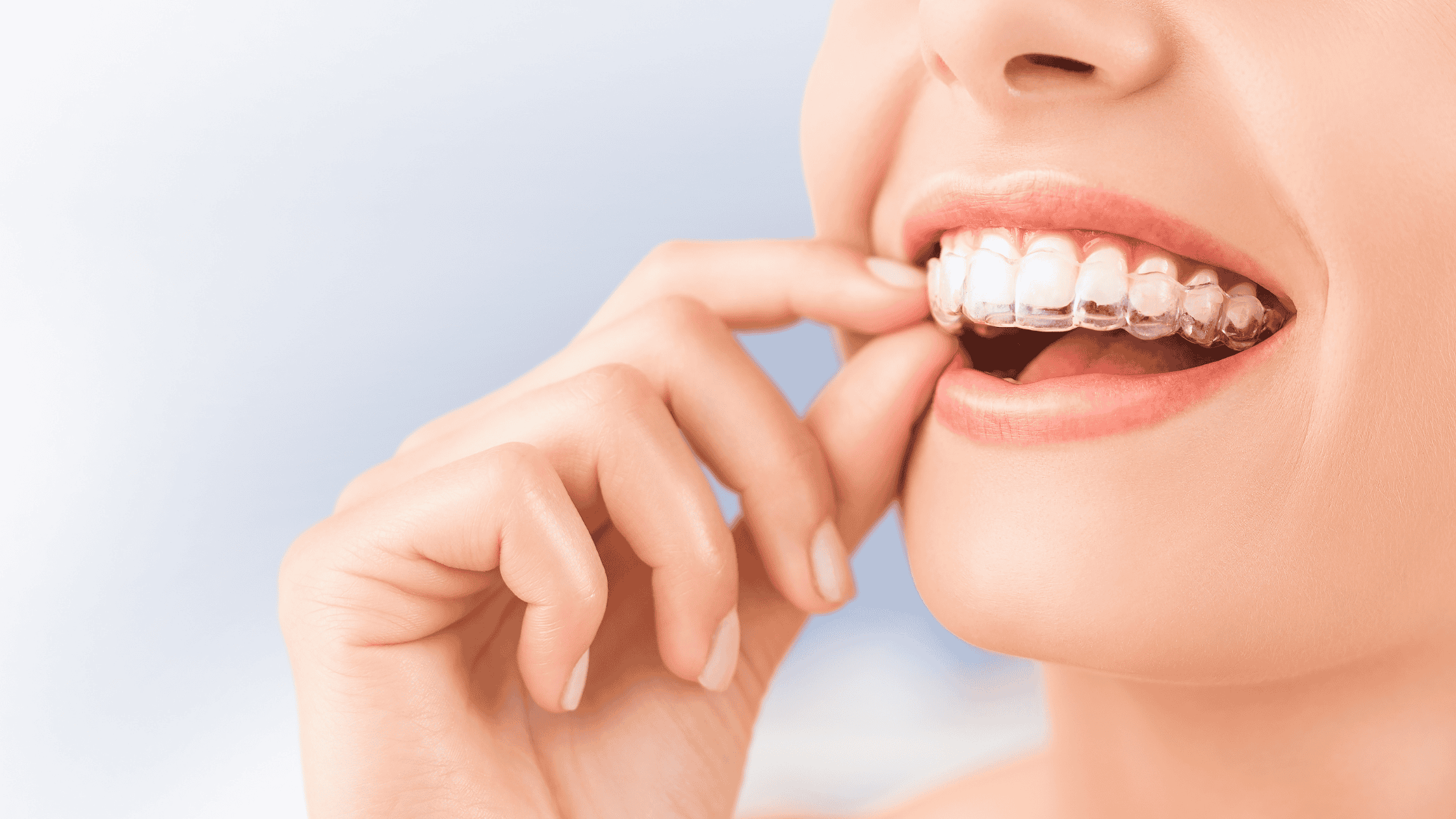 Invisalign Services In Midlothian VA