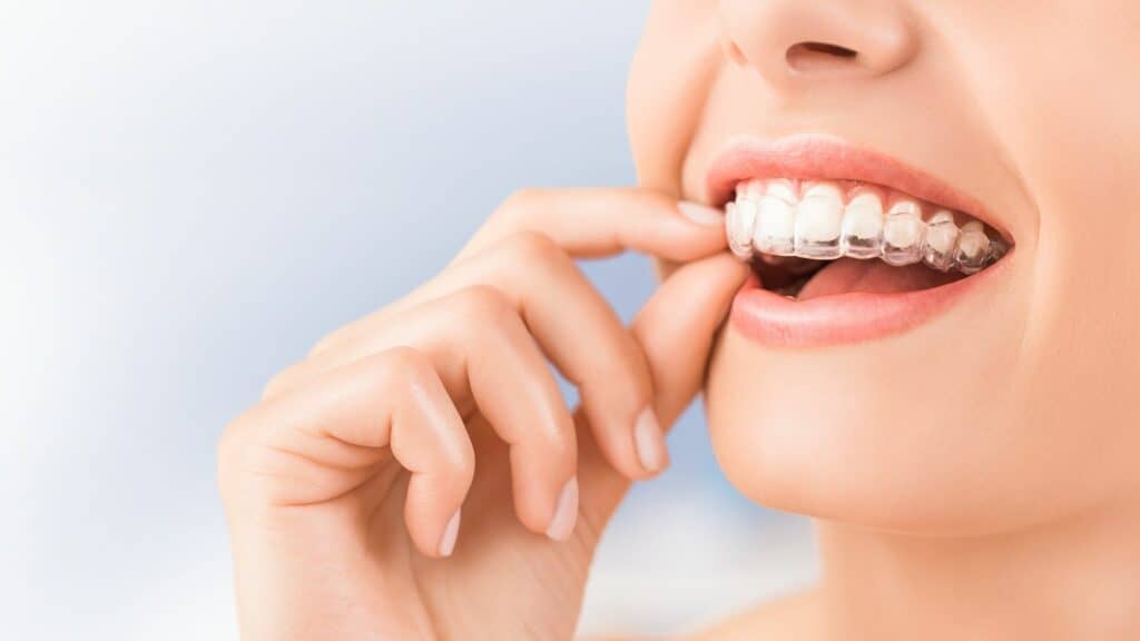 Invisalign Provider In Richmond, VA