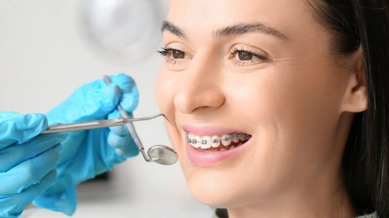 Affordable Orthodontic Treatment Options in Richmond, VA 2 Adult smiling with metal braces, often the most budget-friendly orthodontic option