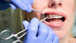 Richmond Braces Consultation