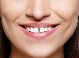 Women with Teeth Gap