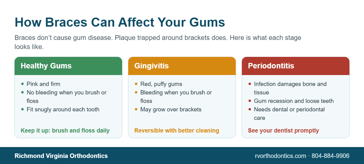 Infographic comparing healthy gums, gingivitis and periodontitis in patients wearing braces